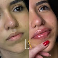 Trazendo harmonia para os lábios de forma delicada e natural! 💋✨❤️‍🔥 . .  . Dra. Lara Antonelli