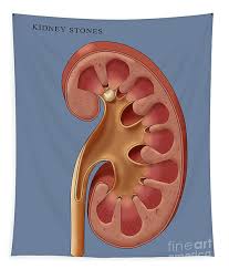 Image result for Nephrolithiasis