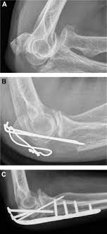 An olecranon fracture with anterior displacement of the radial history. Critical Analysis Of Olecranon Fracture Management By Pre Contoured Locking Plates Sciencedirect