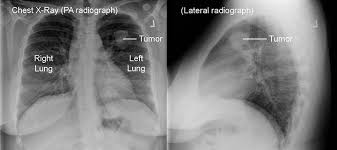 But sometimes they can be a sign of a more serious reaction that needs to be treated. Imaging Tests Lungevity Foundation