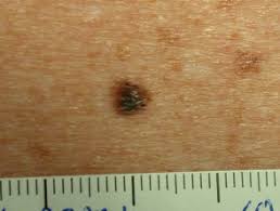 It is a very common condition that appears as pigmented skin spots that are flat. Lentigo Simplex Dermnet Nz