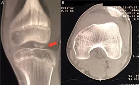 Check spelling or type a new query. Scielo Brasil Femoral Condyle Osteochondral Fracture Treated With Bone Suture After Acute Patellar Dislocation A Case Report Femoral Condyle Osteochondral Fracture Treated With Bone Suture After Acute Patellar Dislocation A
