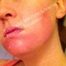 Irritation And Allergic Reactions Tisserand Institute
