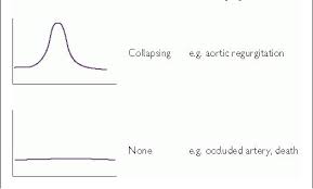 Image result for Collapsing Pulse