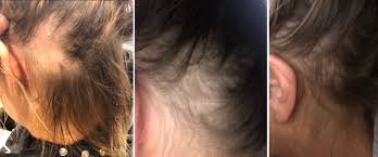 Unfortunately, there is no professionally tested evidence to confirm that it does affect hair loss. Alopecia Treatment With Tcm Eastern Therapies