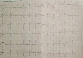 Image result for Extrasystole