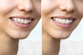 What You Need to Know About a Smile Makeover | Dental & Orthodontics News
