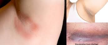 Intertrigo Symptoms Treatment Lume Deodorant