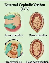 Image result for External Cephalic Version