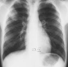1979) dont la plus connue est legionella pneumophila. Unterer Respirationstrakt Abstract Europe Pmc
