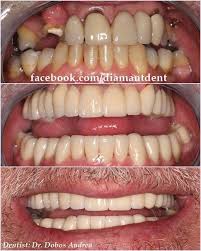 Dentistrymyworlddark Dental Implants Before And After Do You Teethwhiteningja Toothimplant Dental Bridge Tooth Implant Cost Dental Bridge Cost