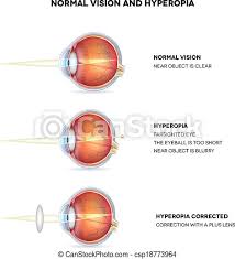 Download vision stock firmware and flash it in your android device using a flash tool to get back the native android experience again. Hyperopia And Normal Vision Hyperopia Is Being Farsighted Illustration Shows Hyperopia Corrected With A Plus Lens Anatomy Canstock