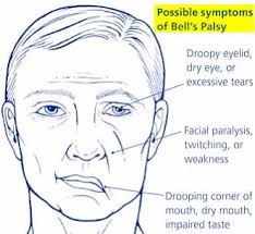 Unfortunately, there are no effective treatments to reduce your symptoms from bell's palsy. Bell S Palsy We Re Speaking To Regular Corks Redfm 104 106 Facebook