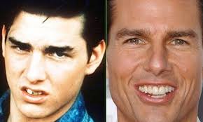 Tom had this tooth symptom fixed by a dentist a while back now. Tom Cruise Teeth Work Besides Nose Job Botox Injections Tom Cruise Also Did Teeth Work At His Very Young Celebrity Smiles Cosmetic Dentistry Celebrity Teeth