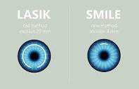 How Long Does SMILE Eye Surgery Last? - A Comprehensive Look at ...