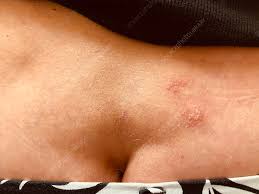 Image result for genital herpes