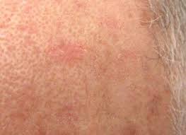 The strongest risk factor for developing skin cancer is ultraviolet (uv) ray exposure, typically from the sun. Baldness Increases Skin Cancer Risk Bald Men Beware Scary Symptoms