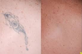 Tattoo removal shop, minneapolis, minnesota. Laser Tattoo Removal In Minneapolis Edina Plymouth Zelskin Com