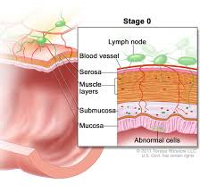 A biopsy confirmed i had adenocarcinoma in my rectum. How We Diagnose Rectal Cancer Dana Farber Cancer Institute Boston Ma