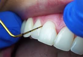 Prevention of gum recession is entirely in your hands. Do Your Gums Grow Back Treatment Prevention