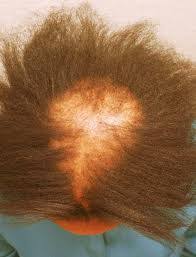 Female pattern hair loss, androgenetic alopecia in females, female pattern alopecia. Hair Loss In African American Women Dermhair Clinic 1 310 318 1500