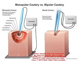 Are available, including standard clamps and forceps. Monopolar Vs Bipolar Cautery