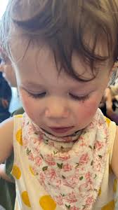 I normally wouldn't post something like this, but hoping it gets seen and  we can get the information we need. My daughter Chloe was bitten in the  face by a dog today