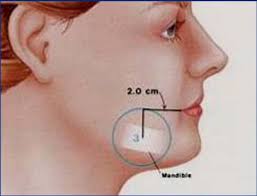 Temple, Cheek & Chin Closure Considerations
