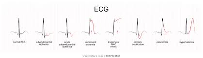 A type 2 mi is a relative (as opposed to an absolute) deficiency in coronary artery blood flow triggered by an abrupt increase in myocardial oxygen. Acute Coronary Syndromes