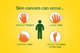 Melanoma skin cancer starts in melanocyte cells of the skin. Abcde Melanoma Self Check Method Complete Overview