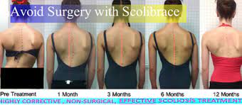 Vancouver Scoliosis Treat Scoliosis Without Surgery