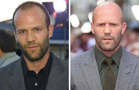 Sure, many celebs are follicly blessed, or they get hair transplants. 19 Bald Celebrities Before After Embracing Baldness
