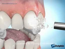 How Orthodontic Braces Are Put On Teeth Young Orthodontics Orthodontics Braces Orthodontics Dental Videos