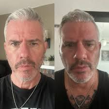 Another little progress report for you. May 2024 vs June 2023. Down about  45 lbs. Looking a bit different, feeling a bit different. The only change I  made was giving up alcohol.