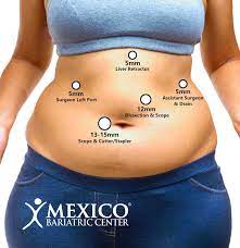 Elizabeth wolinsky had gastric bypass surgery after her body rejected the lap band. Gastric Sleeve Scars Guide To Reduce Scarring Quickly