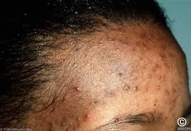 Acne vulgaris