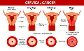 They may be caused by something other than cancer, but the only way to know is to see your doctor. All You Need To Know About Cervical Cancer