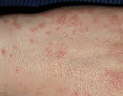 This itchy rash on the buttocks is a common rash for infants and toddlers to suffer from, although it can afflict anybody who wears a diaper, and is the itchy red bump is typically surrounded by a halo and often appears in clusters on the lower legs and feet. What S My Rash Pictures And Descriptions Of 21 Rash Types Plushcare