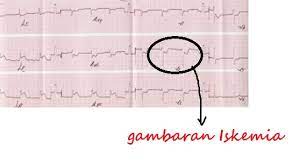 Rempah yang paling sering digunakan untuk mengobati depresi adalah st john's wort. Perbedaan Iskemik Dengan Infark Pada Gambar Ekg Jantung Jantung Area