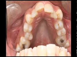They are placed over the front of your teeth to alter the shape, size and colour of an existing tooth. How To Straighten Your Teeth No Pain No Braces As Dentist Tells All Youtube