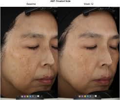 A randomized, controlled, split-face, double-blind comparison of a  multimodality pigment-correcting serum containing lotus sprout extract  versus hydroquinone for moderate to severe facial hyperpigmentation,  including melasma, in a diverse population ...