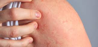 Det er vanligst å få utslettet rundt munnen og på haken. Eksem Hudguide