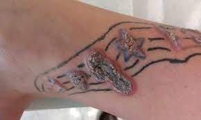 Can I Be Allergic To My Tattoo Tatouage Photo Tatouage Tatouage Au Henne