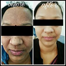 Image result for Photodermatitis