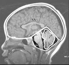 What Do Grossly Unremarkable Suprahyoids Mean Quora