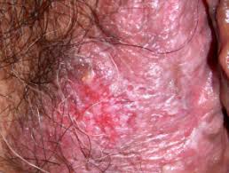 Extramammary Paget Disease Of Skin Dermnet Nz