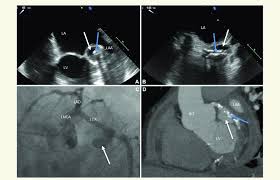 Coronary Artery Disease Imaging: Practice Essentials, Radiography, Computed  Tomography