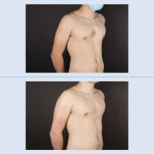 Image result for Pectus Excavatum