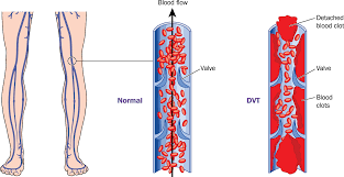 What Is Deep Vein Thrombosis Dvt