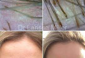 Our melbourne clinic is open and ready to help you feel good about your hair again. Hair Loss Melbourne Vista Clinic